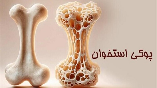 درمان پوکی استخوان مردان؛ به کمک داروها، رژیم غذایی سالم و ورزش مناسب تحت نظر متخصص ارتوپد